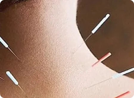 Person getting Dry Needling services